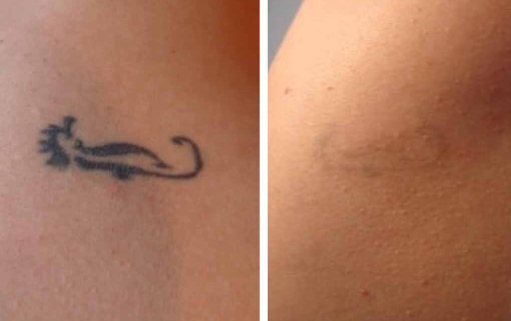 Elimina tus tatuajes de forma segura con láser - LCV Informa
