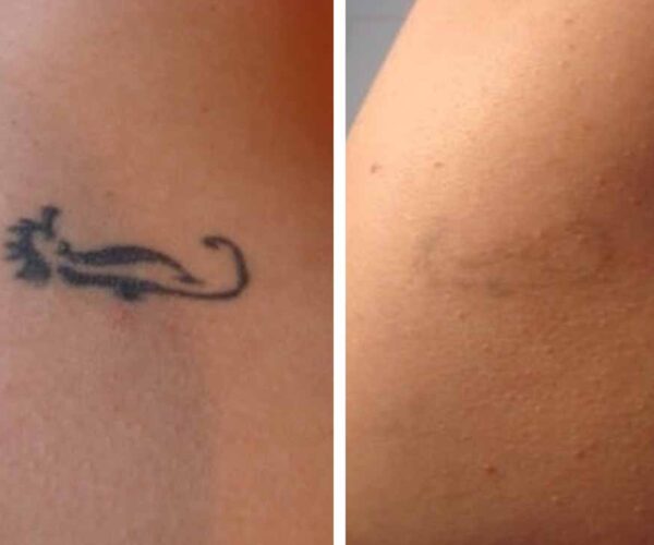 Elimina tus tatuajes de forma segura con láser - LCV Informa